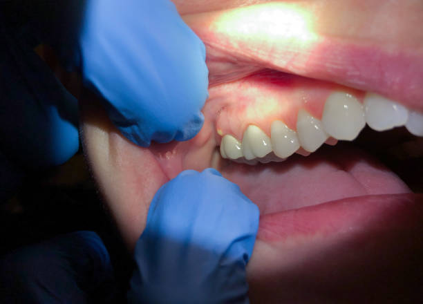 Best Emergency Wisdom Tooth Extraction in Penn Yan, NY
