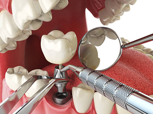 Best Broken or Chipped Tooth Repair in Penn Yan, NY